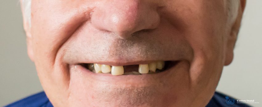 8 Dangers of Missing Teeth You Should Know About