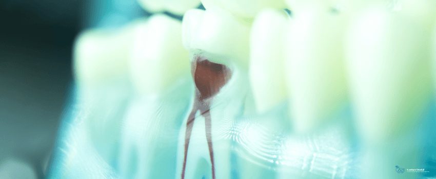 CD-Dental tooth root canal