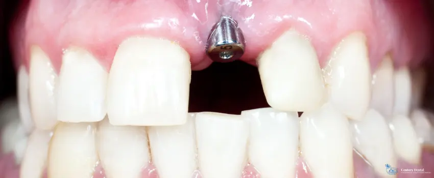CD-Sometimes, patients encounter problems with their dental implants