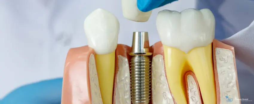 CD-Why do dentists recommend dental implants