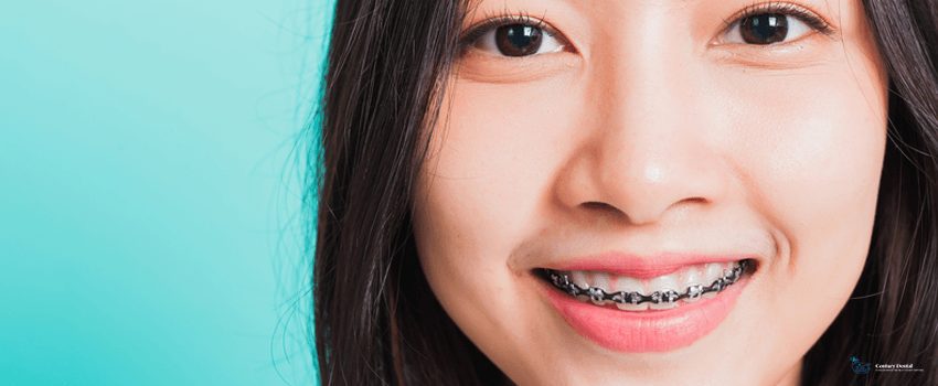 CD-Woman smile have dental braces on teeth laughing