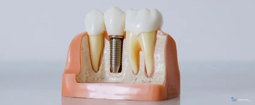 CD-close up shot of dental implant model