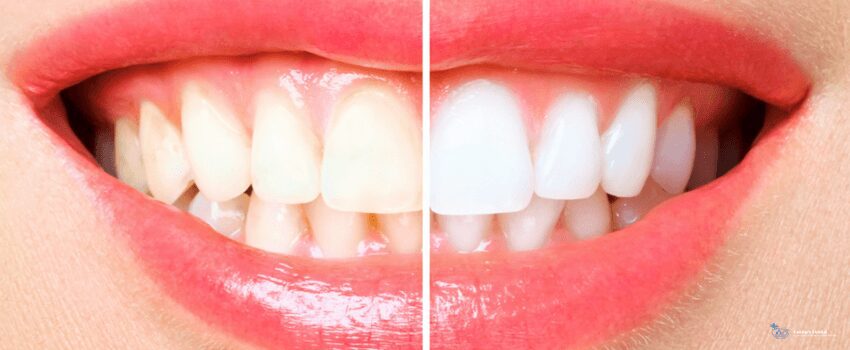 CD-woman teeth before and after whitening