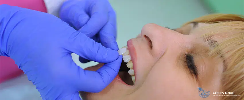 Dental Veneers - Everything You Need To Know