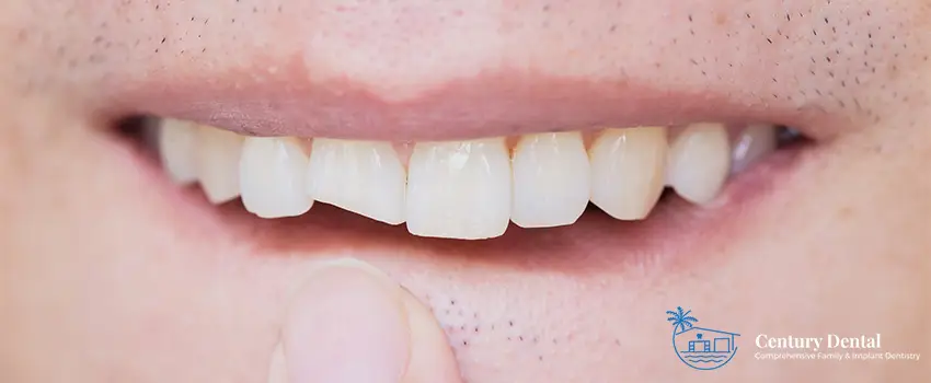 CD Everything You Need to Know About Chipped Teeth