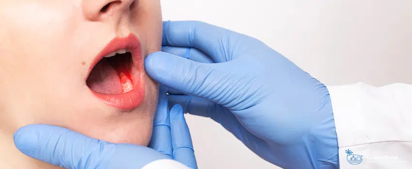 The Link Between Gum Disease and Hypertension