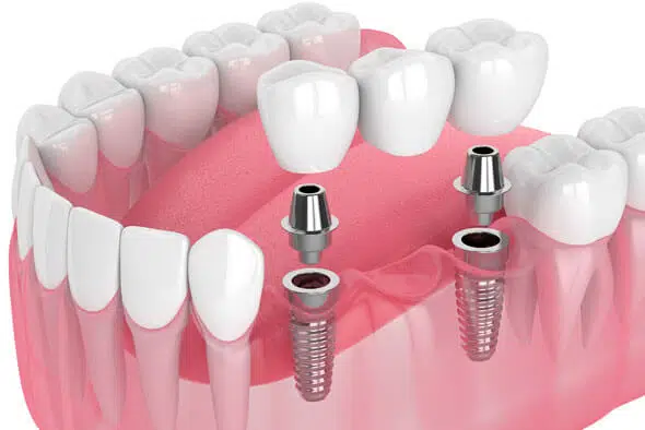 CD Dental Implant Services