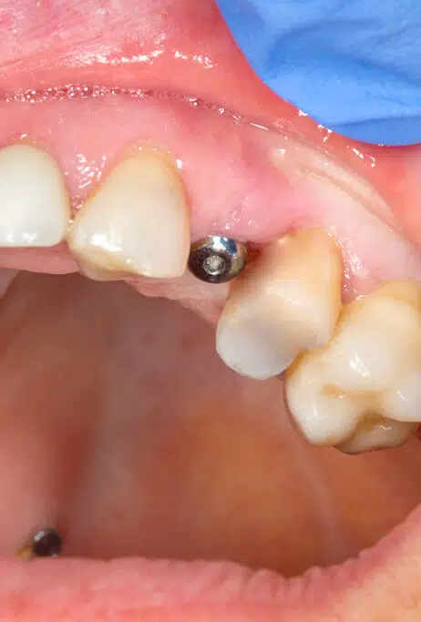 CD Top-Quality Dental Implants in Madeira Beach, FL